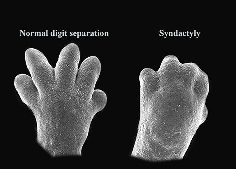 Syndactyly---sm.png